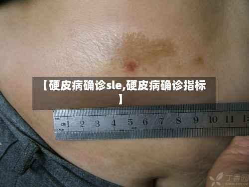 【硬皮病确诊sle,硬皮病确诊指标】