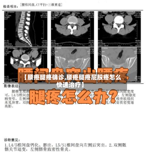 【腰疼腿疼确诊,腰疼腿疼屁股疼怎么快速治疗】