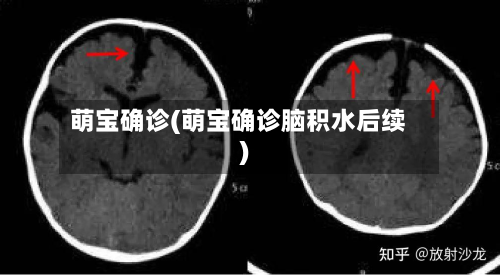 萌宝确诊(萌宝确诊脑积水后续)