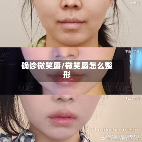 确诊微笑唇/微笑唇怎么整形